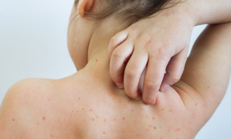 Alarm nga rritja e rasteve me fruth në SHBA, vdes një tjetër fëmijë i pavaksinuar